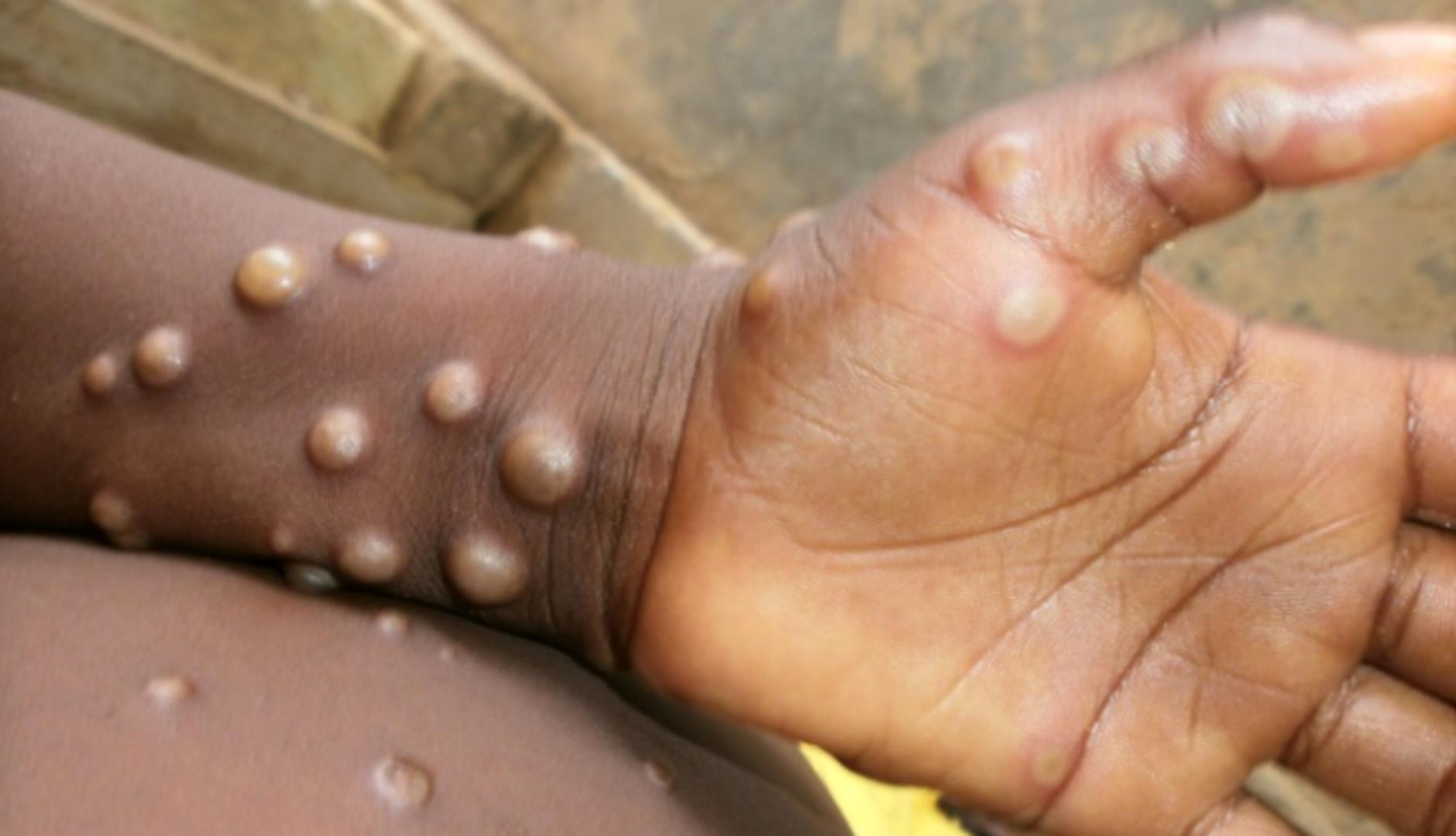 What Is Monkeypox? A Microbiologist Explains What's Known About This Disease